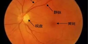 上海眼科医生姚宜：“中风”也会发生在眼睛里，出现这些症状千万别大意！