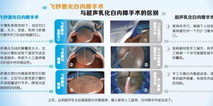 等白内障长熟了再做手术？上海眼科专家郭海科教授：那是以前！