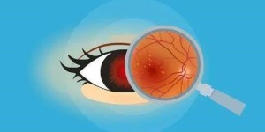 上海眼底病医生姚宜解答：高血压患者为什么容易发生眼底病变?